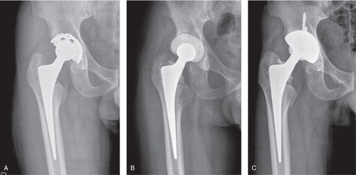 Figure 2. A. A 63-year-old man (patient no. 1) who had an infection after total hip arthroplasty, showing a bone-ingrown femoral stem. B. After the first-stage operation with an articulating cement spacer and retained femoral stem. C. 6 years after the second-stage reconstruction, with no evidence of implant loosening or osteolysis.