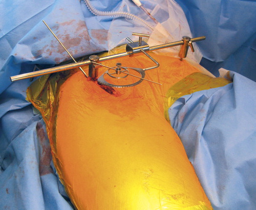 Figure 7. The measuring device is used under fluoroscopy in the anteroposterior plane. It is mounted bilaterally at the anterior-superior iliac spines. The position is secured by inserting small spikes. To secure alignment of the pelvis for angle measurement, a rod connects the spikes. The measuring device is mounted during surgery with the disc for center edge-angle measurement.