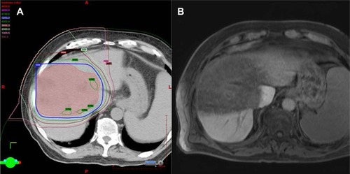 Figure 21 Radiation changes in the liver.