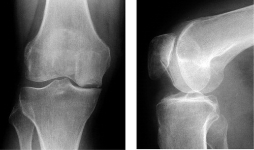 Figure 1. Plain anteroposterior and lateral radiographs showing focal osteonecrosis of the medial femoral condyle.