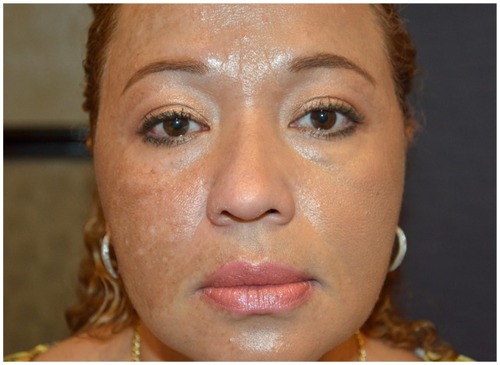 Figure 1 Patient with melasma after half-face treatment with cosmetic camouflage (left face treated).