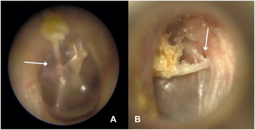 Figure 2. Otoscopy Case 2 (A) and Case 3 (B) showing ear canal with partly extruded piston (white arrows) through the TM.