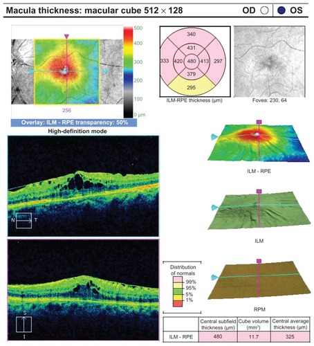 Figure 4 Eye 5 in the series with postoperative cystoid macular edema.