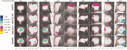 Figure 4. Coronal views showing the dose difference between simulated delivery for tumors in motion and static tumors for all the tumors with motion amplitudes >15 mm. Negative values indicate that delivering the dose while the tumor was moving resulted in lower doses to the region than if the dose was delivered while the tumor was static. The dose differences are presented as % of the prescribed dose. Regions with no color indicate that the dose difference was within ±5%.