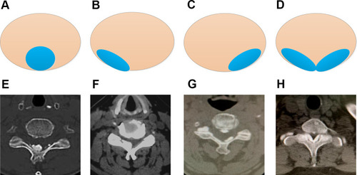 Figure 6 COLF location on Axial CT views. (A and E) Central site of the lamina; (B and F) left side of the lamina; (C and G) right side of the lamina; (D and H) bilateral side of the lamina.