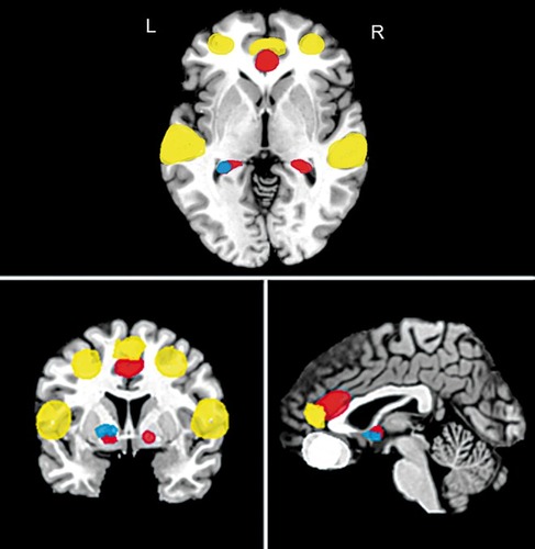 Figure 3. A schematic brain activation map demonstrating areas of pre-CBT treatment activation that predicts better outcome (eg, reduction of anxiety-related symptoms) in PTSD (red), PD (green), GAD (blue), SAD (yellow) and OCD (white). For demonstration purposes only and not accurate depiction of size of activation for each anxiety disorder. Colored regions represent areas of altered activation prior to CBT treatment that predicts improved outcome (eg, reduction of clinical symptoms). PTSD, post-traumatic stress disorder; PD, panic disorder; GAD, generalized anxiety disorder; SAD, social anxiety disorder; OCD, obsessive-compulsive disorder