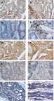 Figure 1 Representative examples of immunohistochemical findings for CD3, CD8, CD45RO, FOXP3, and PD-L1 (original magnification, ×400). (A,B) Positive for intraepithelial and stromal CD3; (C,D) positive for intraepithelial and stromal CD8; (E,F) positive for intraepithelial and stromal CD45RO; (G,H) positive for intraepithelial and stromal FOXP3; (I,J) positive for cytoplasmic and membranous PD-L1.