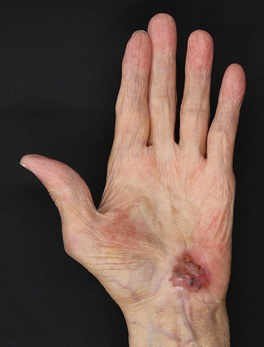 Figure 1 Gross appearance of a red lesion on the left palm of an 82-year-old man who previously underwent immunotherapy; the lesion has a heterogeneous color (black, white, and red).
