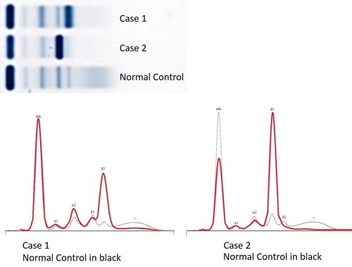 Figure 1. Serum protein electrophoresis in both patients. Case 1 shows a 34 g/L IgG kappa monoclonal protein running in the beta-2 region and marked suppression of polyclonal gamma globulins. Case 2 shows a 48 g/L IgG lambda monoclonal band running in the beta-1 region, a monoclonal-free lambda light chain band in the beta-2 region, and polyclonal decrease in other immunoglobulins.