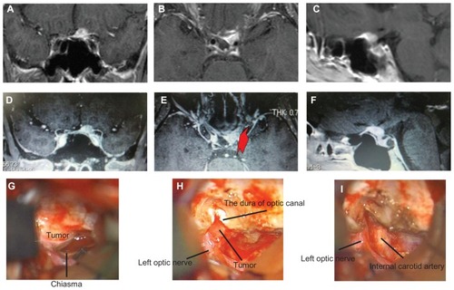 Figure 1 Enhanced magnetic resonance imaging and operative views. (A–C) At the onset, a 9 mm heterogeneous intracranial lesion attached to the tuberculum sellae can be seen. The mass was close to the left optic nerve anterior to the chiasm. (D–F) Preoperatively, thin sliced enhanced magnetic resonance imaging showed the lesion had extended into the left optic canal (red arrow). (G–I) The tumor was successfully removed including the intracranial lesion by opening the optic canal.