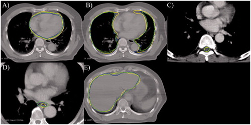 Figure 2. Results of the automatic segmentation of normal tissues. Blue line: manual segmentation; green line: CNN-based automatic segmentation; and yellow line: ABAS-based automatic segmentation. (A) Heart, (B) lung, (C) spinal cord, (D) esophagus, and (E) liver.