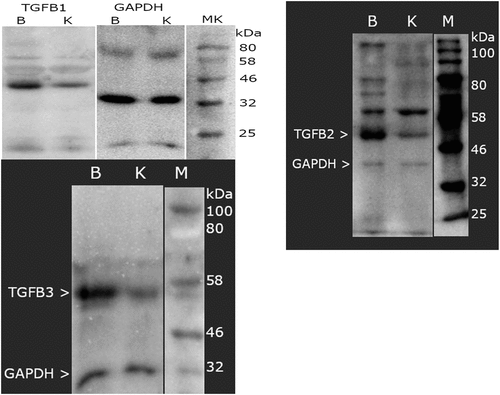Figure 5. Example of electrophoretic separation of TGF- β1–3 and GAPDH in study and control samples. TGF β-1–3, transforming growth factor beta 1–3; GAPDH, glyceraldehyde-3-phosphate dehydrogenase; kDa, kilo Daltons; M, size marker (New England Biolabs Marker); B, sample of yellow ligamentum flavum taken from the study group; K, yellow ligamentum flavum sample from control group participants.