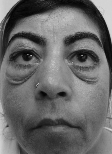 Figure 2 Post-treatment photography shows an partial remission of orbital masses following a course of oral corticosteroids at one month.
