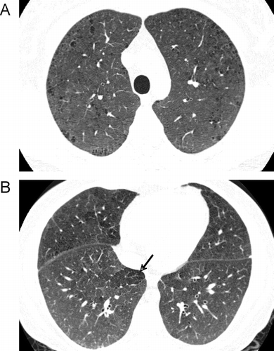 Figure 19 Radiographic appearance of respiratory bronchiolitis-interstitial lung disease (RB-ILD). A 35-year-old heavy smoker with RB-ILD. CT images through through upper (A) and lower (B) lobes show mild centrilobular emphysema, and widespread poorly defined centrilobular nodularity and ground glass abnormality. Focus of decreased attenuation in the right lower lobe is due to air trapping (arrow).