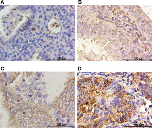 Figure 1 PTPN18 was overexpressed in endometrial cancer specimens. Representative images of PTPN18 immunohistochemistry staining in (A) control tissues (CON), (B) simple endometrial hyperplasia (SEH), (C) atypical endometrial hyperplasia (AEH) and (D) endometrial cancer tissues (EC).