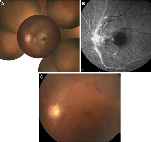 Figure 1 Fundus photograph and fluorescein angiography after surgery.