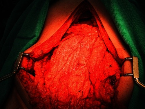 Figure 2 Extensive epithelioid malignant peritoneal mesothelioma involving the omentum.