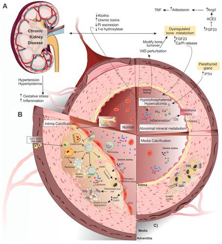 Figure 1 Schematic view of vascular calcification in CKD. (A) As renal function continues to fall, normal defense mechanisms for Pi and Ca homeostasis (PTH, FGF-23, and klotho) become overwhelmed and the endocrine system of FGF23-klotho-VitaminD and RAAS is disturbed. As a result of nephron loss and higher levels of FGF-23, 1α-hydroxylase activity is diminished in the kidney, leading to elevated levels of inhibitor of this enzyme (FGF-23) and a decrease in 1,25(OH)2-vitamin D (calcitriol) productionCitation43 that, in turn, upregulates the production of renin in the kidney. Subsequently, the elevated levels of angiotensin II lead to kidney klotho loss, disruption of FGF-23 signaling, and the impairment of phosphaturia. Elevated levels of FGF-23 may activate the RAAS either by suppressing ACE-2 directlyCitation94 or decreasing calcitriol levels indirectly.Citation107 (B) Ca and Pi deposition in the VSMCs of medial layers may cause VC. (C) In the intimal calcification process, more diverse cells are involved including osteoclast-like cells, Gli1+-MSCs of the adventitia, and CCCs. The interaction of different factors and these cells causes atherosclerosis. Uremic toxins cause VSMCs trans-differentiation into osteoblast-like cells. In the process of calcification, macrophage differentiation into osteoclast-like cells is inhibited. In turn, macrophages increase apoptosis and accumulation of apoptotic bodies through transition into foam cells. A pro-inflammatory form of circulating monocytes (M1 macrophages) promotes the initial calcium deposition within the necrotic core of the lesions. All the above factors together cause atherosclerosis. For more details, see the full text.Abbreviations: CKD, chronic kidney disease; FGF-23, fibroblast growth factor-23; PTH, parathyroid hormone; VC, vascular calcification; MMPs, matrix metalloproteinases; DH-VitD, 1, 25-dihydroxyvitamin D. Gli1+-MSCs, Gli1+ mesenchymal stem cells; CCCs, calcifying circulating cells; ACE-2, angiotensin-converting enzyme-2; RAAS, renin-angiotensin-aldosterone system; HA, hydroxyapatite crystal; ECs, endothelial cells; MQ, macrophage; IS, indoxyl-sulfate; VSMC, vascular smooth muscle cell; OS, oxidative stress.
