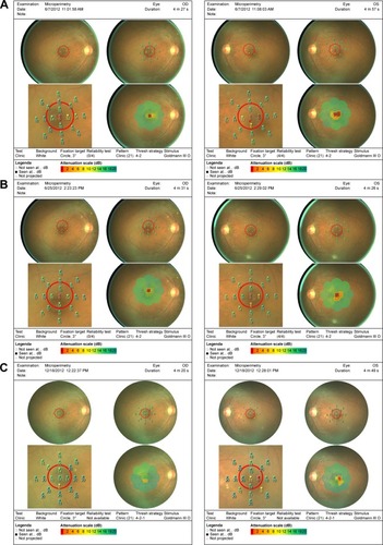 Figure 8 Pre- and post-microperimetry fields on three patients.