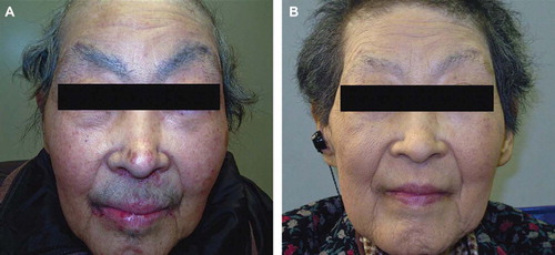 Figure 1. Photography images of the face showing hair alterations (hypertrichosis) induced by erlotinib. Her eye brows, eye lashes, and beard became darker, thicker, and elongated (A). However, these adverse events were resolved after discontinuing erlotinib because of disease progression (B).