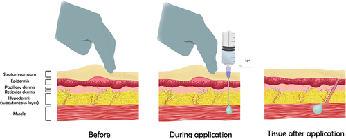 Figure 5 The Z-Track intramuscular (Zigzag) application technique. The skin before, during and after application.