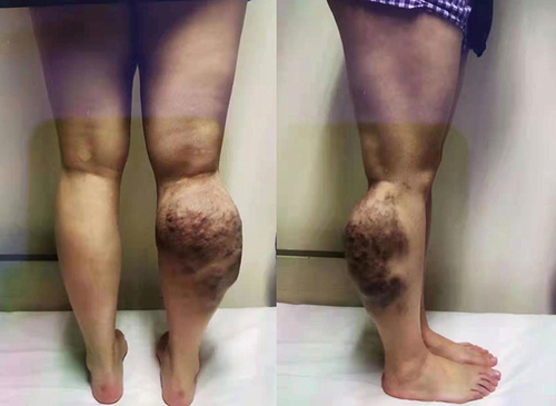 Figure 1 The condition of the patient’s lower limb before the first debridement.