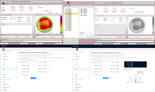 Figure 2 (A) Initial page of a corneal topography-guided surgery, following the input of general patient data. (B) Zernike value, generated based on corneal topography and in accordance with the OSA standard. (C) Entry of the corresponding Zernike value and manifest refraction into the Zhang & Zheng vector-compensation refraction calculator. (D) Output section, indicating the target diopter and the primary vector components following application of the Zhang & Zheng vector-compensation method.