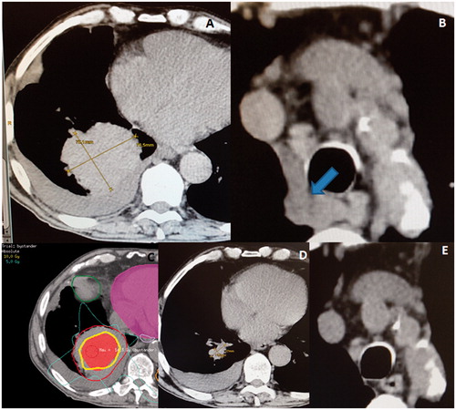 Figure 2. (A) A very voluminous squamous cell carcinoma of the right lung, with a maximum diameter of 10 × 9 cm at the time of the radiotherapy. (B) The arrow showing the asymptomatic mediastinal lymphadenopathies. (C) An induction of the bystander effect with a high-dose partial irradiation of the gross tumor volume (GTV, bigger contour) by targeting the central hypoxic region (smaller area). The centrally located isodose-line corresponds to 10 Gy. (D) A dramatic regression of the treated lesion only 3 weeks later. (E) An abscopal effect among the untreated mediastinal lymphadenopathies.