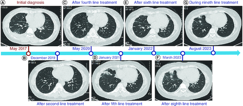 Figure 1. Change in maximum tumor size by chest CT scans.(A) CT image at the time of initial diagnosis. (B) Image after second line treatment. (C) Image after fourth line treatment. (D) Image after fifth line treatment. (E) Image after sixth line treatment. (F) Image after eighth line treatment. (G) Image during ninth line treatment.