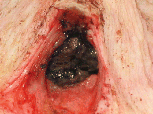 Figure 8. A close up of the cavity shown in Figure 3B after CITT ablation was completed. The cavity inside wall (margins) appears carbonized, but adjacent tissue and superficial skin are undamaged.