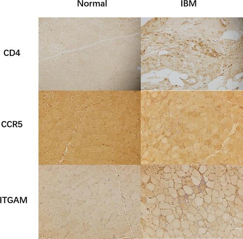 Figure 5 Immunohistochemistry Immunohistology revealed the expression of CD4, CCR5, and ITGAM in IBM and normal muscle tissues.