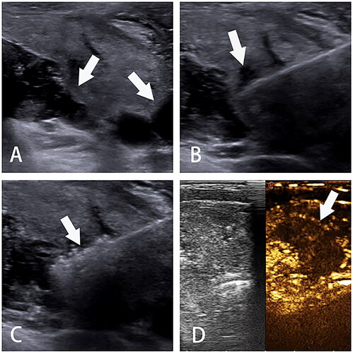 Figure 2. Ultrasonographic imaging of TA. A. Hydrodissection is performed to build up a barrier to protect normal tissues from heat injury; B. The needle or antenna is percutaneously inserted into the PTMC; C. The power turns off with tissue degeneration; D. Contrast-enhanced ultrasonography after ablation with a filling defect. TA, thermal ablation. PTMC, papillary thyroid microcarcinoma.