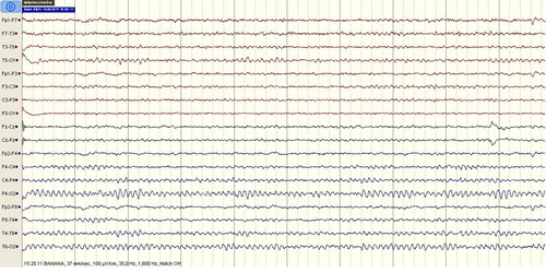 Figure 2. Control EEG of the patient within normal limits.