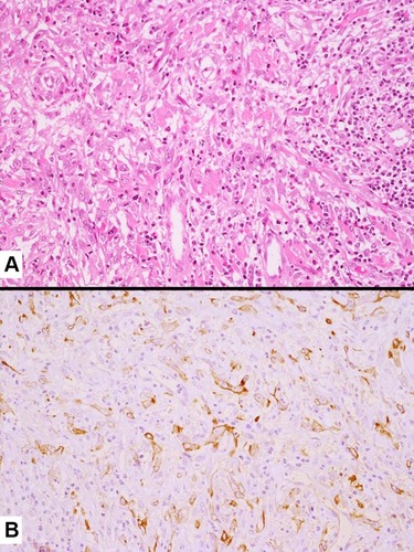 Figure 8 Inflammatory-type spindle cell carcinoma showing a chaotic proliferation of spindle cells with prominent nucleoli into collagenized stroma with a mixed inflammatory infiltrate (A). Positive staining with pan-cytokeratins (clone AE1/AE3) revealing the epithelial/carcinoma differentiation of spindle elements (B).