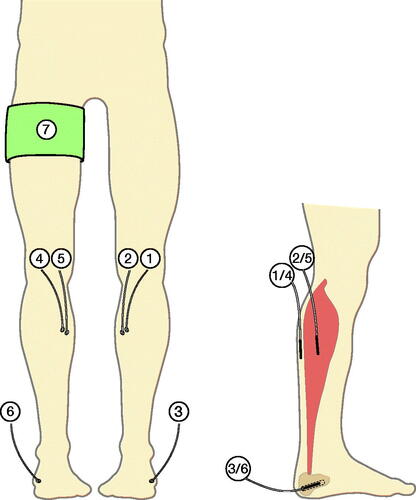 Figure 1. Illustration of the inserted microdialysis catheters. Cefuroxime concentrations were obtained by means of microdialysis catheters placed in non-tourniquet subcutaneous tissue (1), non-tourniquet skeletal muscle (2), non-tourniquet calcaneal cancellous bone (3), tourniquet subcutaneous tissue (4), tourniquet skeletal muscle (5), and tourniquet calcaneal cancellous bone (6). A tourniquet cuff (7) was placed on the leg scheduled for surgery.