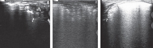 Figure 7. Inability of the US to differentiate between subpleural consolidations stemming from: pneumonia (left image), atelectasis (middle image), and hemorrhage (right image).