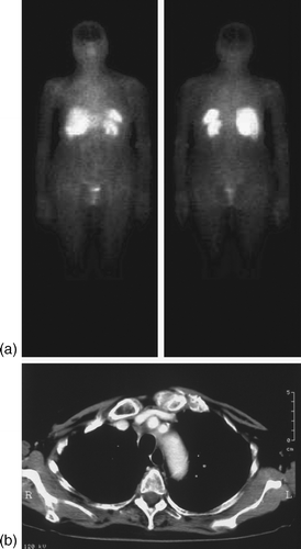 Figure 2.  Images after treatment. 111In-octreotide scans (upper) and CT-scan images (lower) show a complete response.