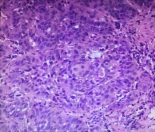 Figure 2 Histopathological imaging of lesions from the esophagus.