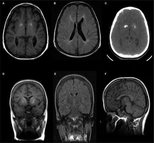 Figure 2 Neuroimaging of the affected subjects.