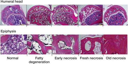 Figure 1. Illustration of histological criteria for ONF. The photomicrographs illustrate normal bone (A, F), fatty degeneration (B, G), early necrosis (C, H), fresh necrosis (D, I), and old necrosis (E, J) (stain: hematoxylin and eosin). The upper row shows whole femoral head (original magnification: ×20) and the lower row shows key findings of each category at high magnification. The fatty degeneration stage has fatty degeneration in the bone marrow (G), the early necrosis stage has myelocyte necrosis in bone marrow (H), the fresh necrosis stage has osteocyte necrosis (I), and the old necrosis stage has appositional bone formation (J).