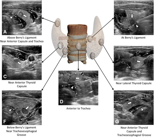 Figure 4. (A–G) US images of improved hydrodissection, as well as a schematic diagram of target nodules (white arrow) at different locations. The ACS hydrodissection (black arrow), VS hydrodissection (white arrowhead), and post-thyroid hydrodissection (black arrowhead) are shown as hypoechoic or mixed echoic bands on the images. The flow directions of the isolating fluid are shown as white thin arrows.