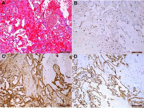 Figure 2 Pathology and immunohistochemistry result (200×). (A) Microscopic finding presents proliferation of erythrocytes within a dilated vascular structure. (B) Ki-67 labeling index was about 5%. Immunohistochemistry shows the tissue was positive for CD31 (C) and CD34 (D).