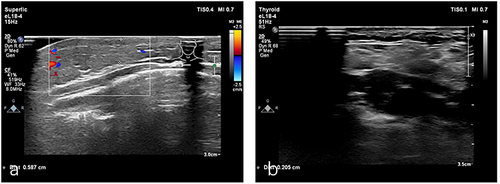 Figure 2 (a) B-ultrasound examination showed hyperechoic area with vascular echo. (b) Follow-up B-ultrasound showed scattered hyperechoic areas with a little blood flow signals.