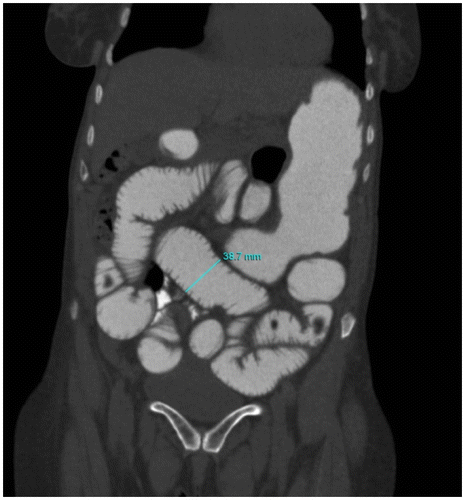 Figure 4: Coronal post-oral contrast CT abdomen showing markedly dilated jejunal loops measuring 3.8 cm from outer wall to outer wall