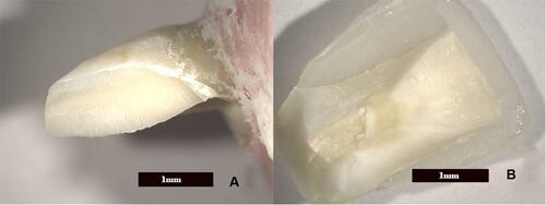 Figure 7 Cohesive failure in which the tooth structure is fractured (A) while the porcelain was not damaged (B).