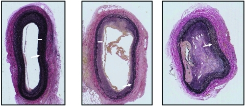 Figure 2 Representative light micrographs of sections (5 μm) of injured carotid arteries of three rabbits inoculated with decalcified human arterial-derived nanoparticles. All tissue was collected 5 weeks post-inoculation and stained with an elastin van Giesen stain. Sections are shown at the lowest (5X) magnification in order to show the entire artery. Uninjured arteries in these rabbits are indistinguishable from that shown in Figure 1, upper left panel. Injured arteries from rabbits injected with decalcified human arterial-derived nanoparticles exhibited a spectrum of vascular healing, ranging from disruption of the internal elastic lamina with minimal development of intimal hyperplasia (left panel), disruption of the internal elastic lamina and greater intimal hyperplasia than developed in the saline-injected rabbits (middle panel), to complete occlusion with canalization and calcification (right panel). Arrows indicate internal elastic lamina, bars indicate intimal thickening.