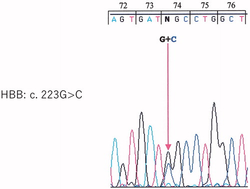 Figure 3. Direct sequencing of exon 2 shows a missense mutation of the β-globin chain at codon 74 (GGC>CGC) (Gly→Arg).