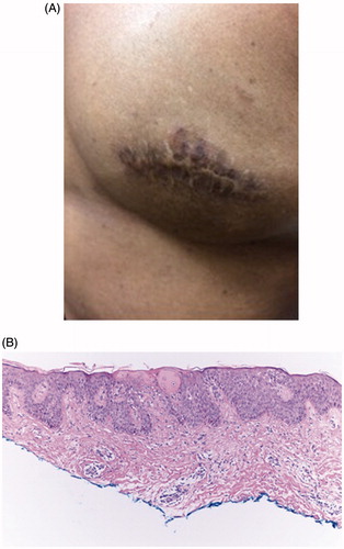 Figure 1. Clinical and histopathologic features of nummular eczema (Case 1). (A) Erythematous, hyperpigmented, scaly plaque overlying the surgical scar on the left breast. (B) Hematoxylin–Eosin biopsy section showing spongiotic dermatitis at x10 magnification.