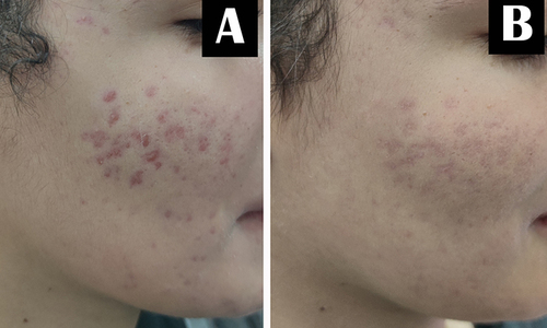 Figure 1 A 24-year-old female patient with atrophic acne scars. (A) Before treatment. (B) Marked improvement after treatment with fractional CO2 laser and nanofat injection.