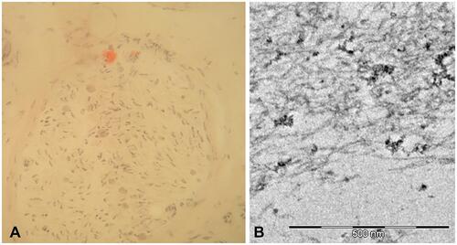 Figure 3 Sural nerve biopsy from a patient with late-onset FAP. Congo red staining showed a small amyloid deposition (A). Ultrastructural analysis with electron microscope confirmed short and thin amyloid fibrils (B).